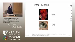 A Case of Melanomalytic Glaucoma and Discussion of Uveal Melanoma