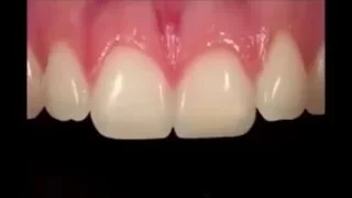 Восстановление передних зубов (видео реставрации переднего резца)