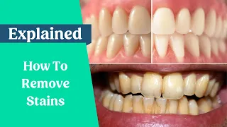 How to remove stains from the teeth