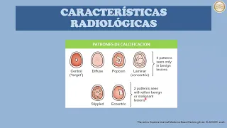 Nódulo Pulmonar