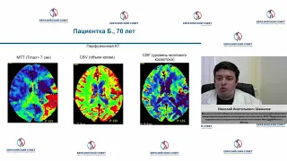 Возможности специализированного питания в процессе медицинской реабилитации после инсульта