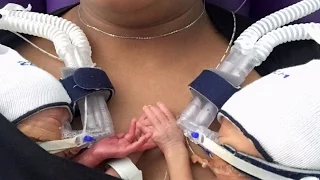 Premature Twins Born 11 Weeks Early Can't Stop Holding Hands After Birth