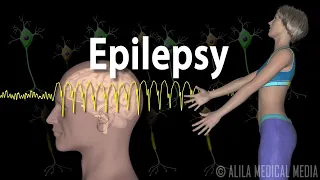 Epilepsy: Types of seizures, Symptoms, Pathophysiology, Causes and Treatments, Animation.