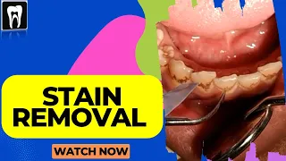 Dental Cleaning EXPLAINED | Stain Removal Teeth | Stain Removal | Black stain teeth
