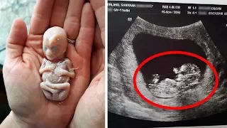 Mom Delivers Baby, But 6 Weeks Later Doctors Find His Deadly Unborn ‘Twin’ Hidden Inside
