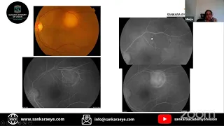 Posterior Uveitis Case Based Lecture Series - Sankara Academy of Vision #Let'sGetonwithExams