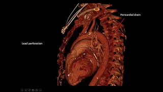 Cardiac Devices: What Is It and Where Should It Be?