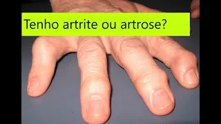 Como diferenciar artrose de artrite nas mãos: guia simples e completo.