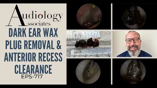 DARK EAR WAX PLUG REMOVAL & ANTERIOR RECESS CLEARANCE - EP717