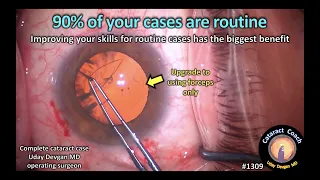 CataractCoach 1309: 90% of your cataract surgery cases are routine