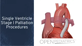 Single Ventricle Stage I Palliation Procedures by D. Beke | OPENPediatrics
