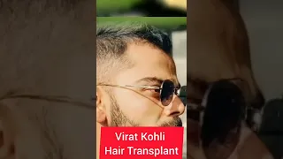 Virat Kholi Hair Transplant l Celebrity Hair Transplant Cricket Team #shorts