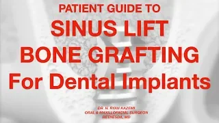 Patient Guide To Sinus Lift Bone Grafting For Dental Implants