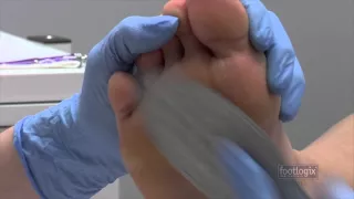 How to Remove Callus | Foot Callus Remover