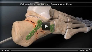 Calcaneal Fracture Percutaneous Plate