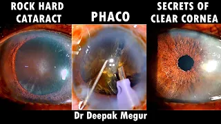 ROCK HARD CATARACT:- PHACO :PATIENCE IS A GREAT VIRTUE TO HAVE . Dr Deepak Megur