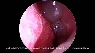 Nasal polyps on endoscopic examination