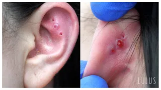 DON'T WATCH THIS Piercing Removal If You Have A Weak Stomach!! 🤢