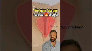 TIROU EXCESSO PELE VAGINA #CIRURGIAINTIMA e não contou pra ninguém!! #ninfoplastia #cirurgiaplastica