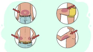 Insulin Injections حقن الأنسولين