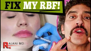 BOTOX FOR THE MOUTH CORNERS // Down Turnd Mouth Fix
