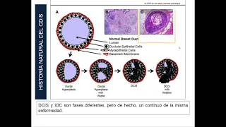 Telecapacitación 2021: Cáncer in situ de mama