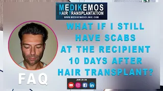 #9 Medikemos  Q/A -  What if I still have scabs at the recipient 10 days after my hair transplants?