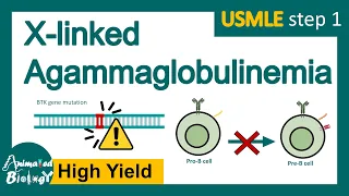 X linked agammaglobulinemia | Agammaglobulinemia | XLA |USMLE step 1