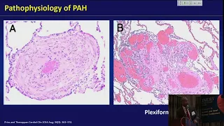 Pulmonary Hypertension: Review of Diagnosis and Treatment