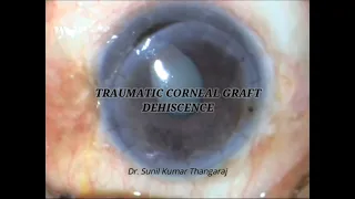 Traumatic Corneal Graft dehiscence