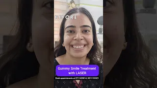 Gummy Smile Treatment with LASER; Dr. Srishti Bhatia #laser #teeth #smilemakeover