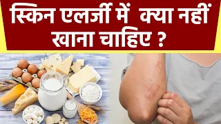 Skin Allergy होने पर नहीं खानी चाहिए ये चीजें वरना...| Boldsky