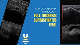 Full thickness Supraspinatus tear on ultrasound