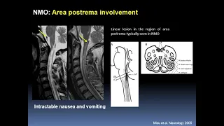 MRI of spinal cord