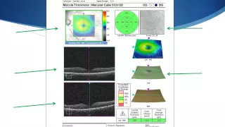 OCT Tutorial On Interpreting Cirrus OCT Macular Scans