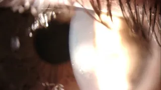 Corneal foreign body with a twist