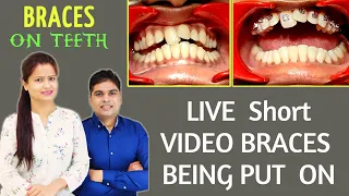 braces on teeth | braces being put on👩‍⚕️😍