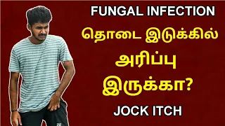 தொடை இடுக்கில் அரிப்பு இருக்கா? | Fungal infections | Jock itch | Causes | Prevention | Tamil | MM