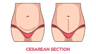 Cesarean Section: Surgical Delivery of Your Baby