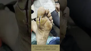 Diabetic Foot  Before After Treatment #shorts