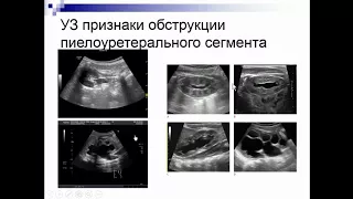 Синельникова Е.В. «УЗД обструктивных нарушений мочевыводящей системы у детей»