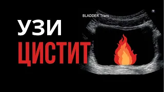 Цистит и УЗИ. Ультразвуковая картина некоторых видов острого и хронического цистита