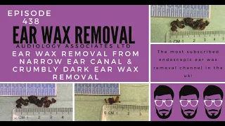 EAR WAX REMOVAL FROM NARROW EAR CANAL & CRUMBLY DARK EAR WAX REMOVAL - EP438