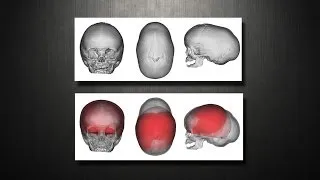 Craniosynostosis - Virtual Cranial Vault (skull) Reconstruction