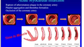 acute coronary syndrome-台大