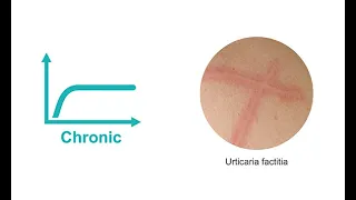 Dermatology 101  Diagnosing a transient rash as urticaria