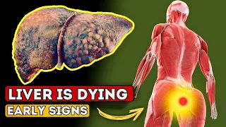 LIVER is DYING! 12 Weird Signs of LIVER DAMAGE