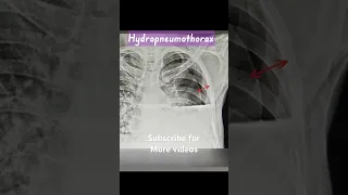 Hydropneumothorax