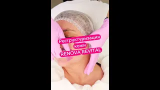 Реструктуризация кожи RENOVA REVITAL