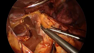 Gastric Bypass Revision for Large Pouch and Short Roux limb
